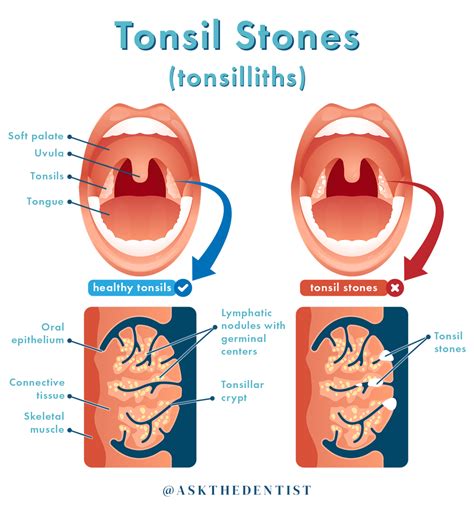 Tonsil stones are complex bacterial debris accumulation in the crypts of tonsils. . Vyvanse tonsil stones